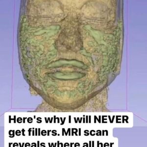 Doctor Reveals: MRI Scan Of The Face Of A 33-Year-Old Woman Reveals Where All Of Her Filler Went